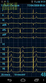 cardiax mobile ecg