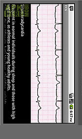 electrocardiogram ecg types